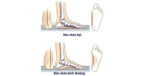 Các Bài Tập Cho Bàn Chân Bẹt Hiệu Quả: Hướng Dẫn Chi Tiết Để Cải Thiện Và Giảm Đau