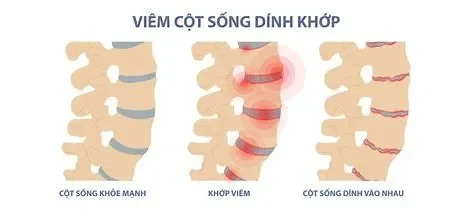 Các Bài Tập Cho Người Viêm Cột Sống Dính Khớp Hiệu Quả: Giảm Đau, Tăng Cường Vận Động Và Cải Thiện Tư Thế