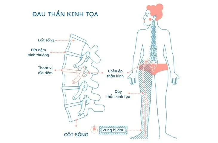 Các Cách Điều Trị Đau Thần Kinh Tọa Hiệu Quả Nhất? Tổng Hợp Từ Chuyên Gia