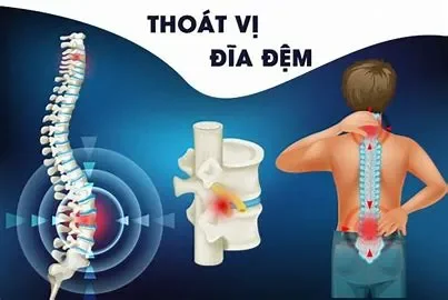 Cách Điều Trị Vật Lý Trị Liệu Thoát Vị Đĩa Đệm? Các Phương Pháp Và Bài Tập Hiệu Quả