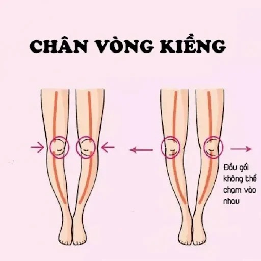 "Bóc tách" Chân vòng kiềng ở người lớn: Nguyên nhân và mức độ