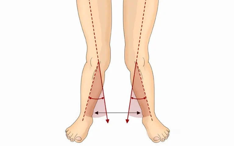 Dấu Hiệu Chân Chữ X Ở Người Lớn? Nhận Biết Và Những Điều Cần Biết