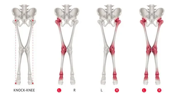 Chân chữ X ở trẻ em là gì?