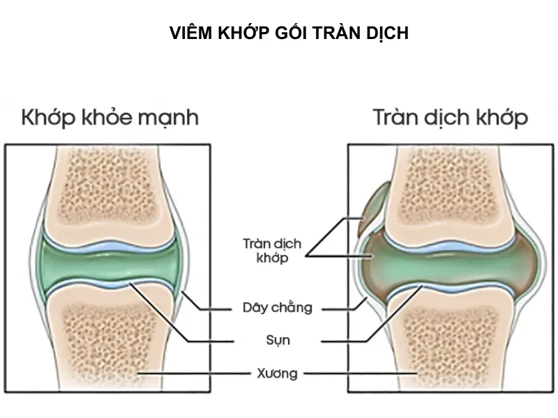 "Giải mã" tràn dịch khớp gối: Bạn đã hiểu đúng về nó chưa?